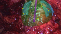 Augmented Reality visualization during laparoscopic prostatectomy