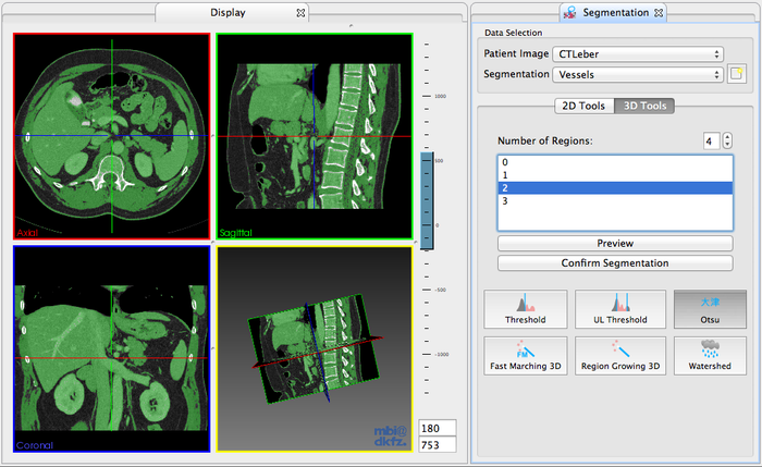 File:MITK$$SegmentationRedesign$Otsu 2.png