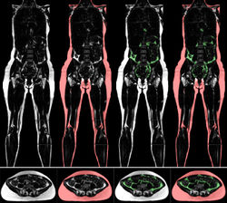 Adipose tissue analyse