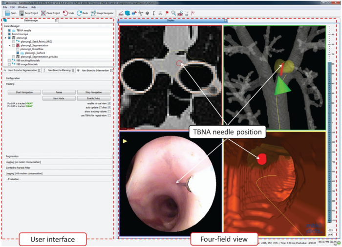 File:Projects$NavigatedBronchoscopy.png