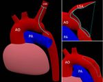 Simulation of Congenital Heart Defect
