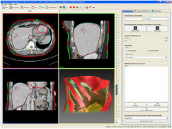 Ablation planning