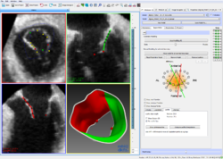 Mitral valve modeling project