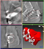 3D c-arms image of heel bone